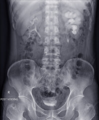  Intravenous pyelogram or I.V.P is an X-ray exam of urinary tract after injection contrast media agent  .