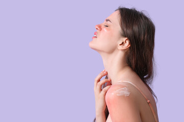Allergic young woman with sunburned skin and cream on lilac background, closeup