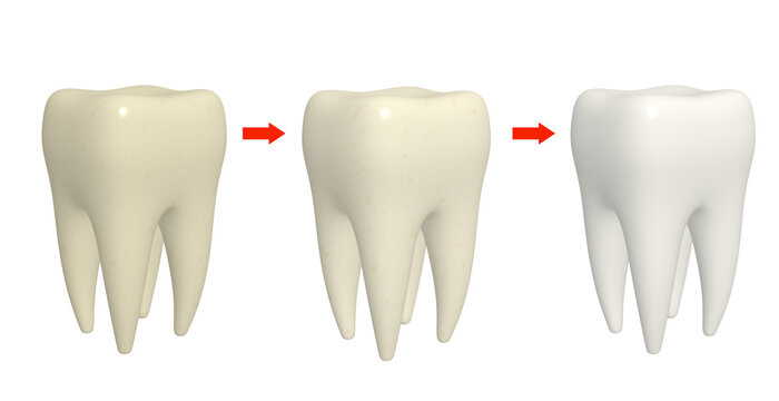 Cleaning tooth process. Human tooth with different enamel color. Isolated on white background. 3d render