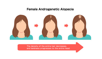 Progress of Female Androgenetic Alopecia. Vector illustration - obrazy, fototapety, plakaty
