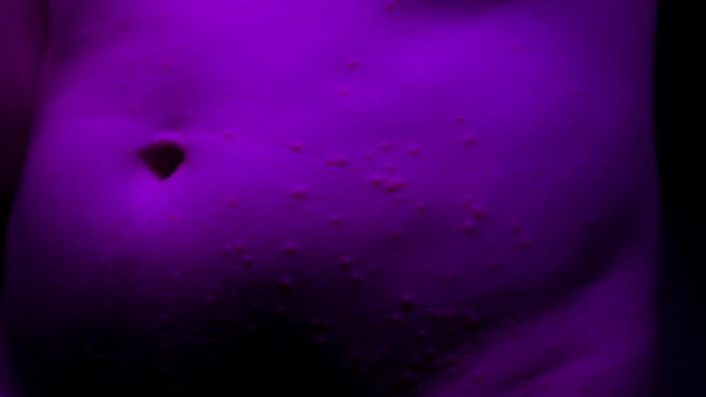 Medical Body acne, Stomach pimples, Suspected insect bites, Potential allergic response, Intense itchiness, stylized close-up shot.