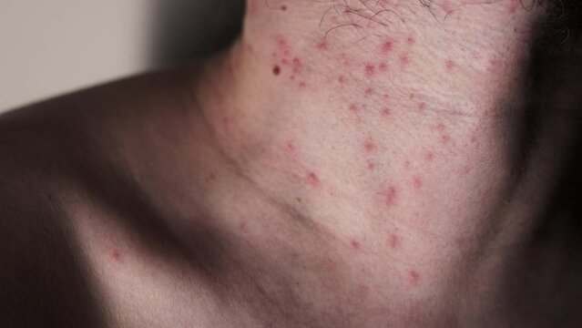 Pimples on the body, neck. Possible insect bites, allergic reaction. Severe itching. Closeup of man's chin.