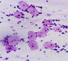 Pap's smear. Inflammatory smear with HPV related changes. Cervical cancer. SCC.