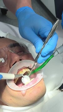 teeth cleaning middle-aged man plaque calculus in mouth lip and cheek retractor doctors 4 hands cleaning teeth suction plaque on teeth visible gums 