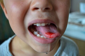 Close-up of lips, tongue, protrusion of blood. Child's bitten tongue.
