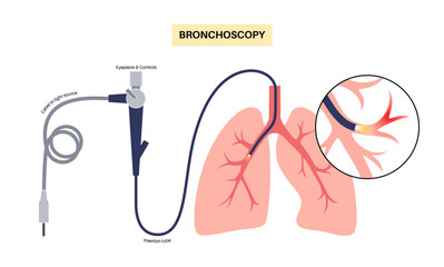 Bronchoscopy procedure concept