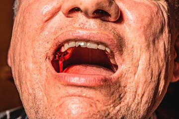 Close up man open mouth, jaw with teeth, detailed sealed bloody tooth after surgery in dental...