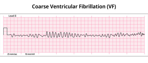 ECG Coarse Ventricular Fibrillation - 8 Second ECG Paper - Electrocardiography Medical Vector Illustration