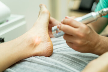 An unrecognizable podiatrist performs laser therapy on an athlete's foot. Laser therapy treatment, laser in podiatry. Foot care in medical centers. - obrazy, fototapety, plakaty