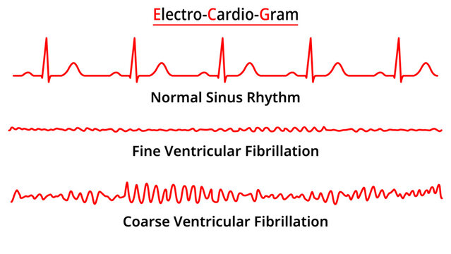 Set of ECG Common Abnormalities - Fine vs Coarse Ventricular Fibrillation (VF) - Normal Sinus Rhythm - Electrocardiography Vector Medical Illustration