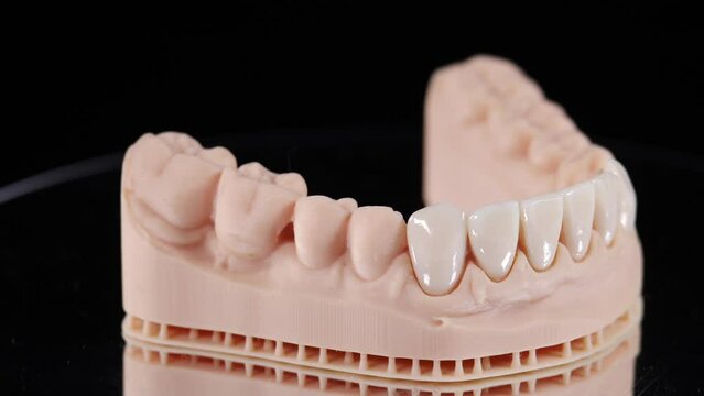 Veneers for teeth on jaw model. Rotating on black background. Artificial teeth. Ceramic dentures and crowns. Zirconium crown. Dental and teethcare care. installing veneers. Dental veneer placement