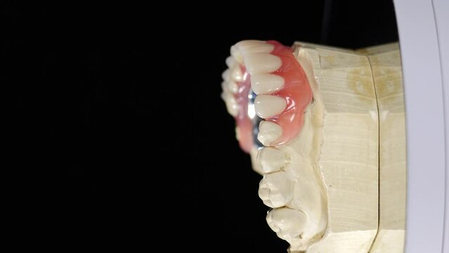 Dental teeth replacement metal construction. Vertical footage. Shot on black background. Dentures tooth. Artificial Dental Teeth Treatment on jaw Model. 4 k video