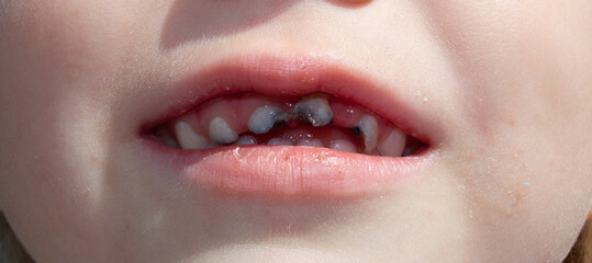 Rotten milk teeth in a child close-up. Milk teeth with caries in a child.