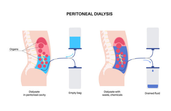 Peritoneal dialysis concept