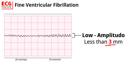 ECG Fine Ventricular Fibrillation - Electrocardiogram Study Guide - Medical Vector Illustration