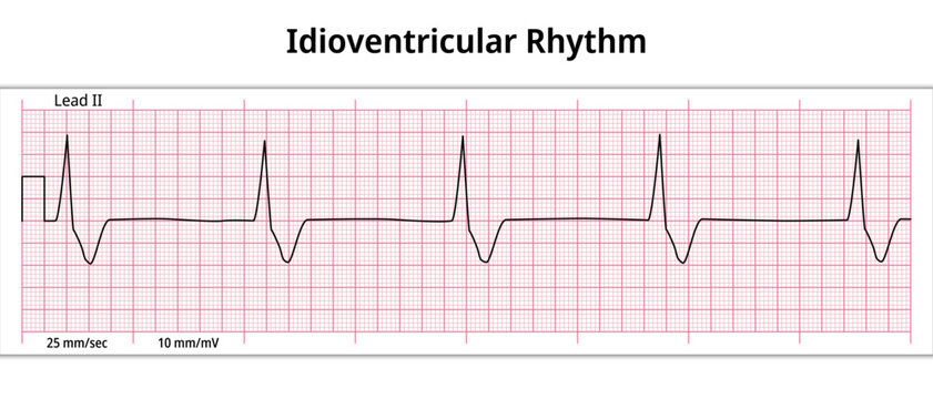 ECG Idioventricular Rhythm - 8 Second ECG Paper - Electrocardiography Medical Vector Illustration