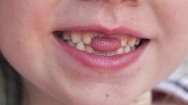 Close-up of a child's mouth without teeth. A girl puts her tongue through a hole where there are no teeth. A girl without her two upper deciduous teeth