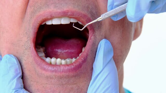 dental prosthetist examines oral cavity patient, charismatic mature man 60 years old open mouth, shows teeth with temporary fillings and metal, titanium pins for prosthetics or splinting, prosthetics