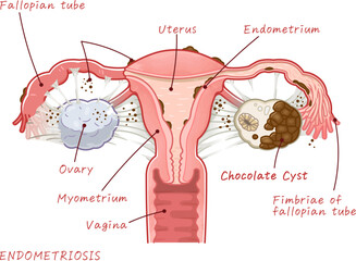 Obraz premium ENDOMETRIOSIS、Chocolate Cyst、ovary、uterus、illustration