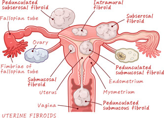 Uterine fibroids、ovary、uterus、illustration