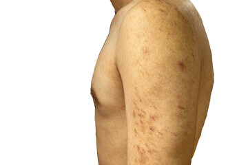 Acne scars on arms