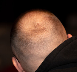 Close up of a bald man's head with hair loss problem
