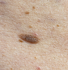 mole on human skin as a background.