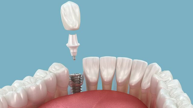 Dental implant installation and crown placement. 3d animation