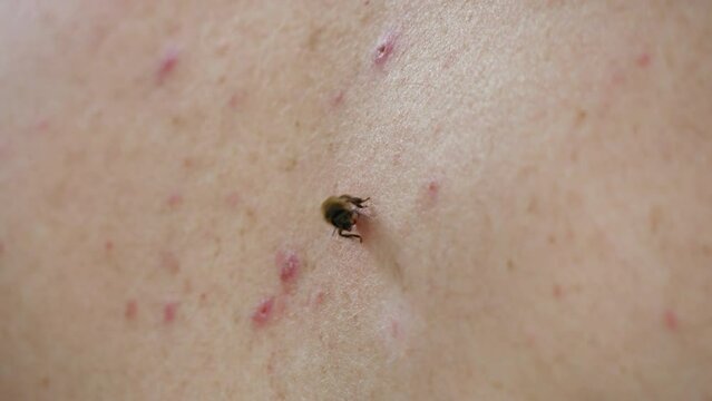 A honey bee stung a man. When bitten, the bee leaves the poison sac. Allergy to insect stings, honey bees