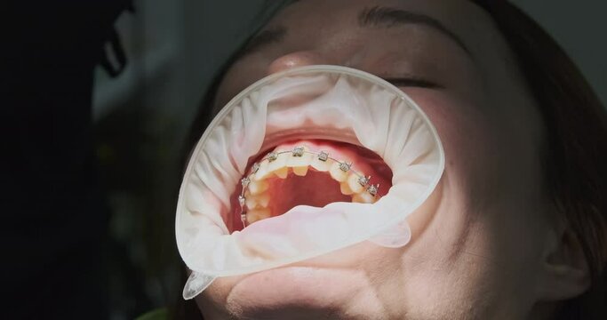 Orthodontist is trying to remove the glued braces patient's teeth with dental flat. Close-up, process of removing braces after long-term wear, even teeth.