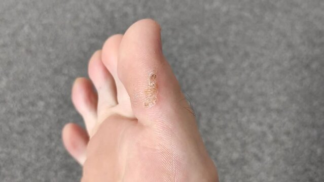 Large dry callus on the big toe