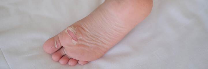 Heel of child with flaky skin after burn or injury closeup. Consequences after transferred enterovirus infection and syndrome hand foot mouth concept