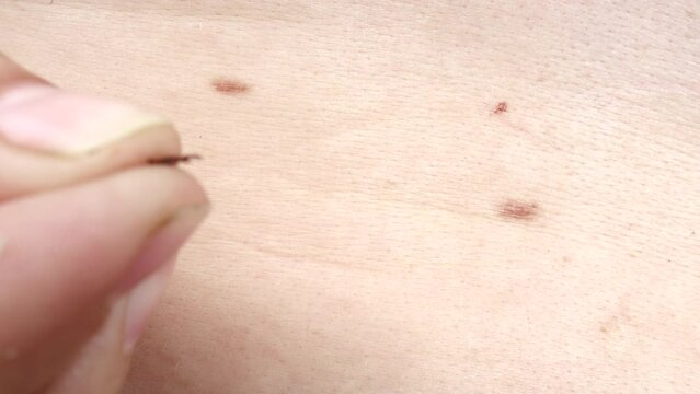 Small Insect Parasite Mite Crawls On a Man's Skin Macro Shot. Tick in Hand Close Up. Ticks Carry Encephalitis Disease