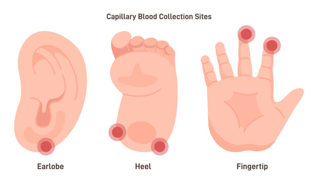 Capillary blood sampling sites. Collection of capillary blood from