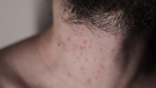 Allergic reaction, lice bug bites - Severe itching on the neck.