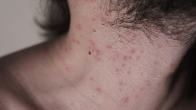 Man with inflamed cystic acne on his neck and jawline area, close up.
