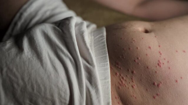 Itchy Allergic Reaction on the stomach. A Caucasian man is sleeping while his belly is covered in acne, bumps, pimples.