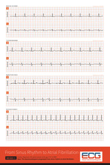 In clinical practice, mitral stenosis is a common disease that causes atrial fibrillation. This is a 7-year electrocardiogram follow-up of a female patient with mitral stenosis.