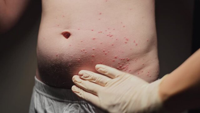 close-up - person examines the abdominal area of a man, where numerous bumps are visible, likely indicating an allergic reaction caused by insect bites.
