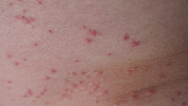 Macro skin rach with acne, pimples, bumps, bug bites.