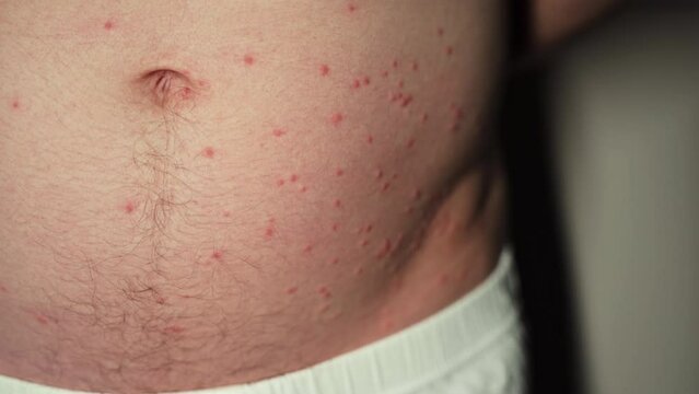The abdominal region - multiple bumps that are likely attributed to insect bites sustained during outdoor camping activities.