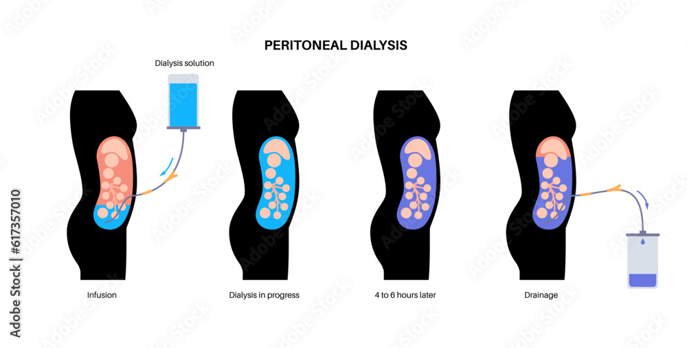 Wall mural Peritoneal dialysis concept