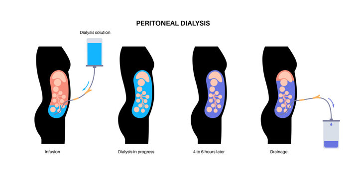 Peritoneal dialysis concept