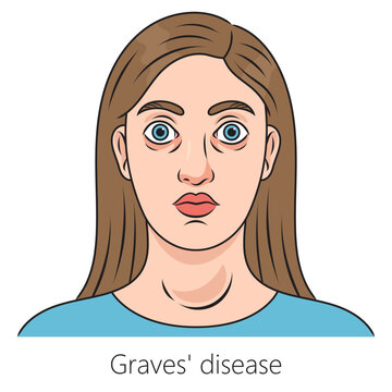 Woman with Graves disease toxic diffuse goiter diagram schematic vector illustration. Medical science educational illustration