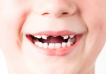 Losing primary teeth, also known as milk teeth change. Close-up of baby teeth lost.