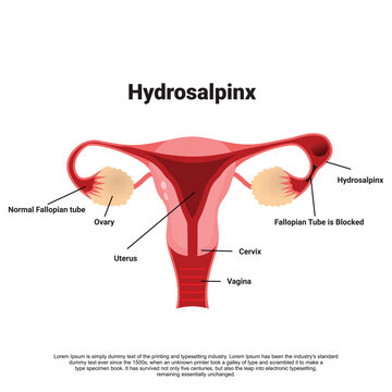 Hydrosalpinx diagram, Obstructed Follopian tube, Infection or membrane covering the fallopian tube cause blockage