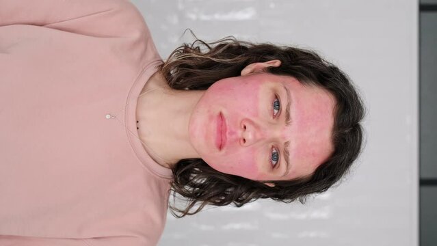 Vertical video Close-Up Portrait Sad Young Woman with pain Skin real Damage Burns from Unsuccessful DIY Beauty Treatments, Chemical Peel Dermapen. Female Unfortunate Skin Home Care Mistakes 9x16 OMG 