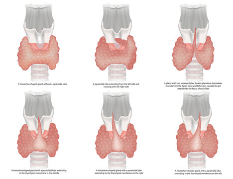 Illustration of the classification of the thyroid gland shapes. The anatomical variations and types of thyroid gland and Pyramidal lobe. Morphological features pyramidal lobe