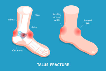 3D Isometric Flat Vector Conceptual Illustration of Talus Fracture, Ankle Trauma