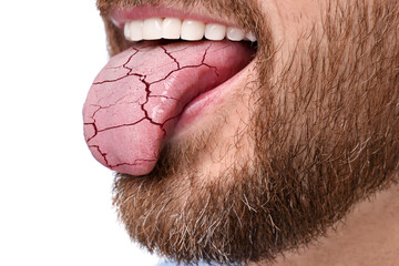 Dry mouth symptom. Man showing dehydrated tongue on white background, closeup